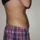 1 week after smart lipo - side